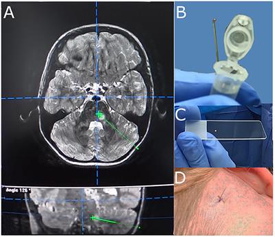 Diagnostic Yield and Complication Rate of Stereotactic Biopsies in Precision Medicine of Gliomas